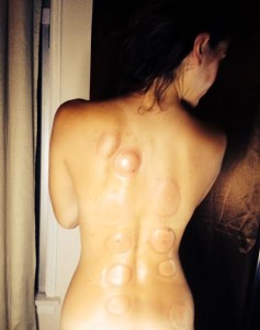 chinese cupping therapy