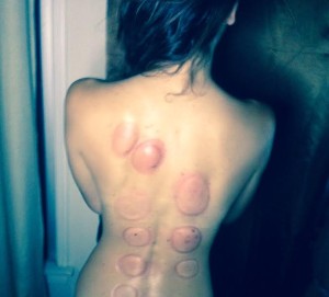 chinese cupping therapy on back